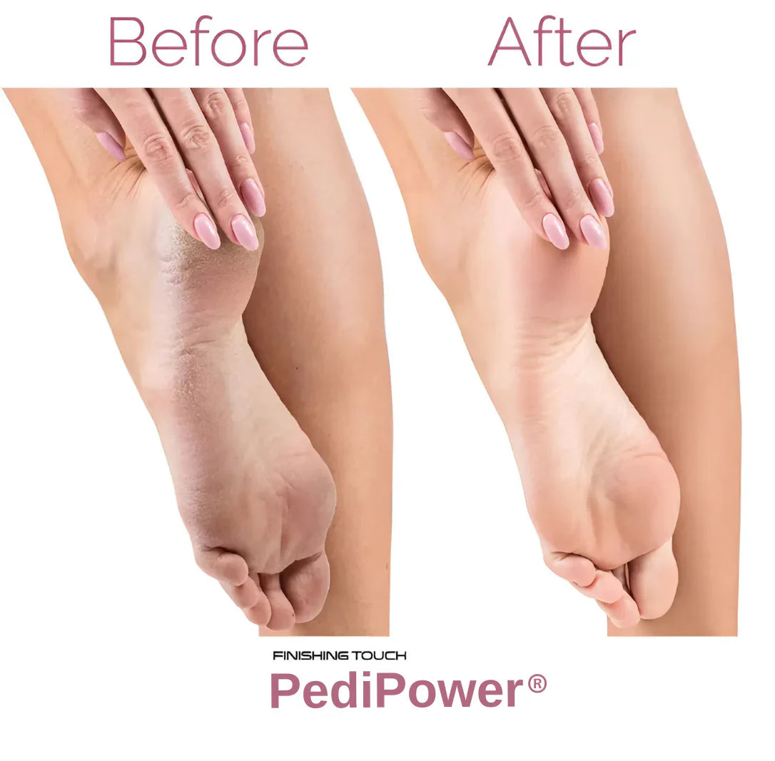 Pro Electric Callus Remover